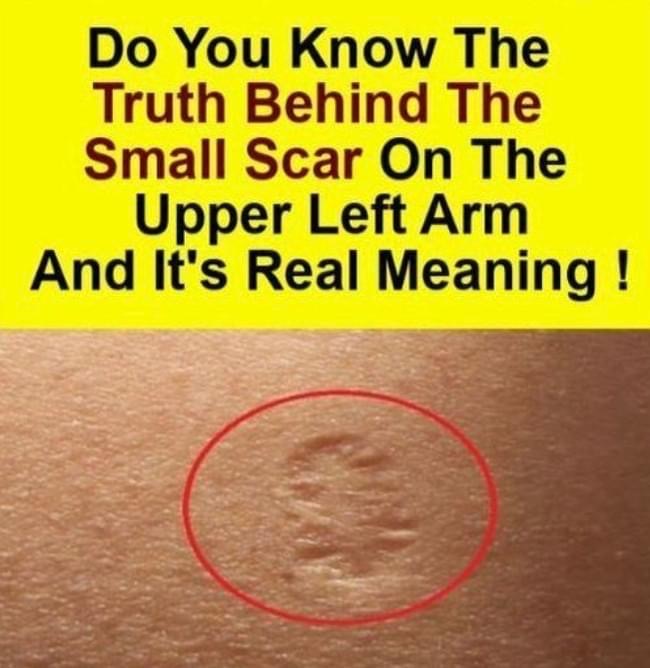 Why did the smallpox vaccine scar?