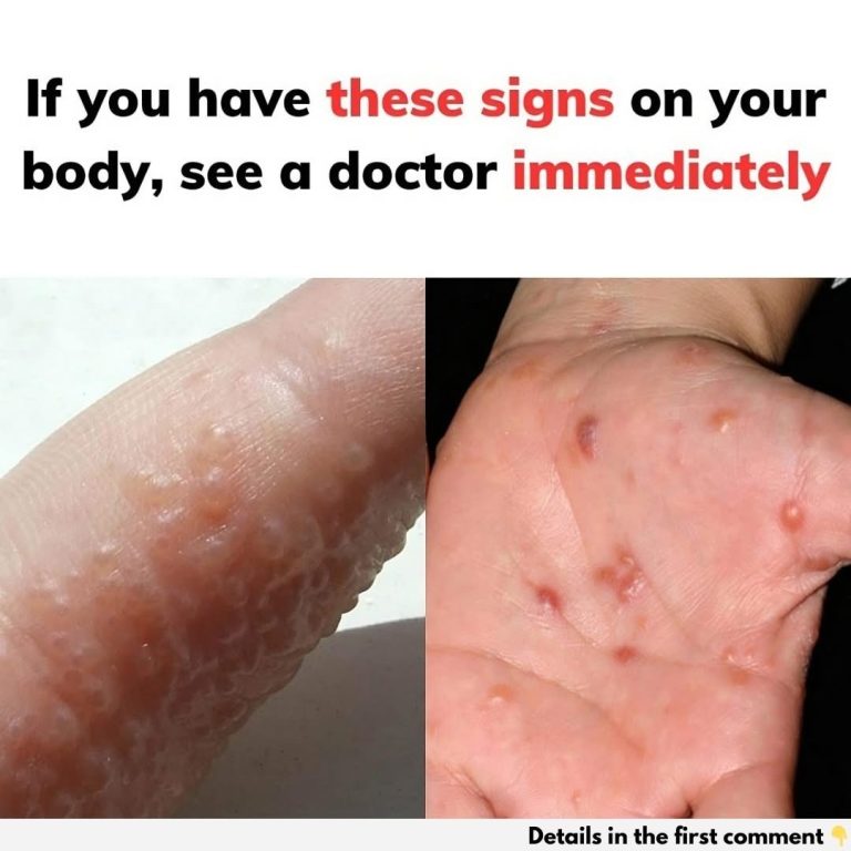 lf you have these sings on the body see a doctor immediaeIy.