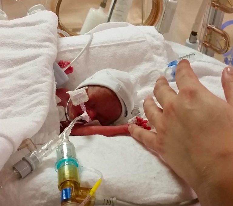 The Amazing Story of Tru Beare, Born Weighing Just One Pound