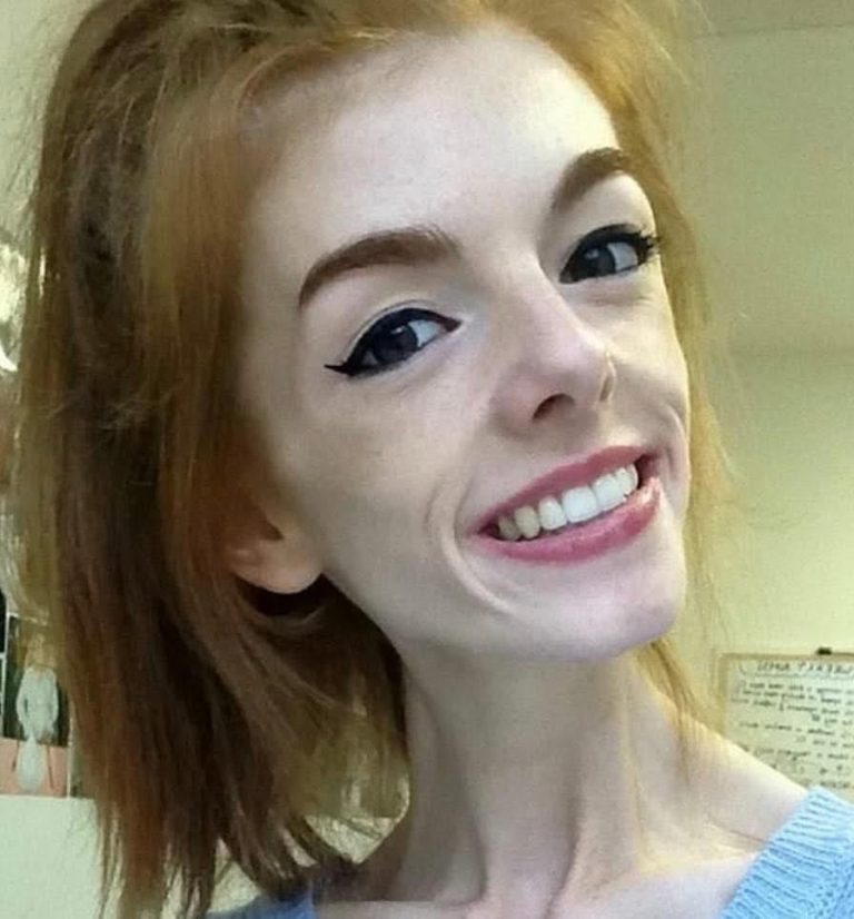 She Survived on One Slice of Bread a Day, But Wait Until You See Her Journey Now—Truly Inspiring