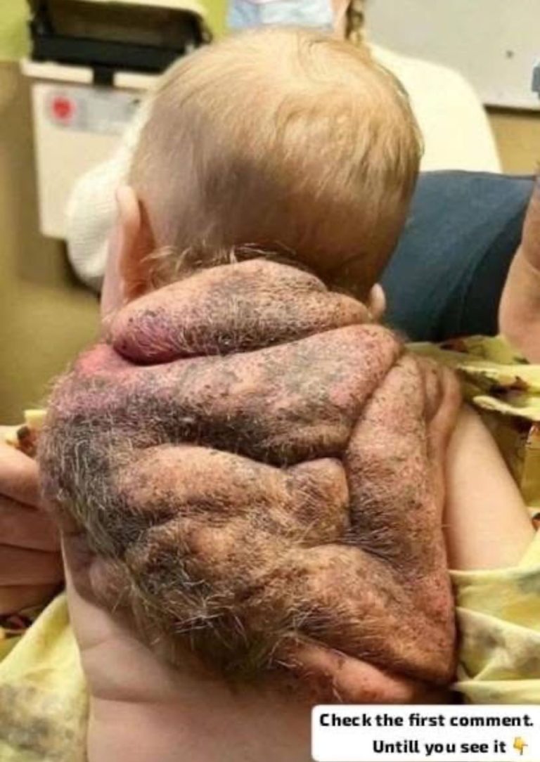 “ Boy born with ‘shell’ “