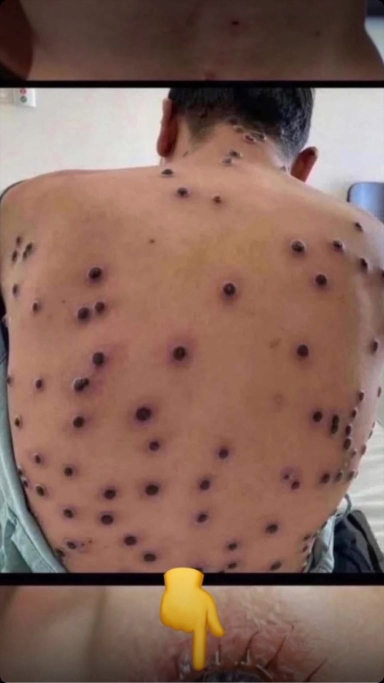 Head Acnes
