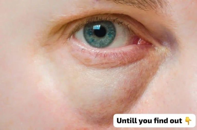 What Dark Circles Under Your Eyes Might Mean