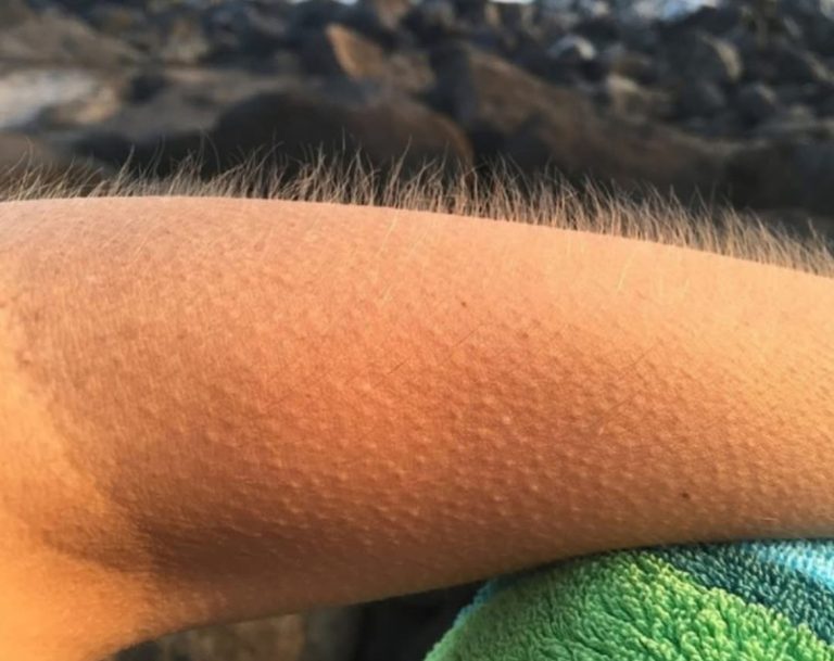 What causes us to get goosebumps when experiencing strong emotions