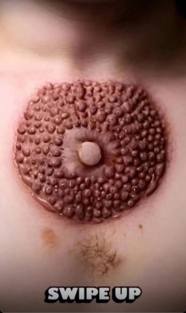 SKIN blackhead treatment