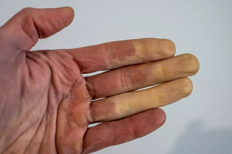 Common disease could be why your fingers turn a different colour in cold winter months