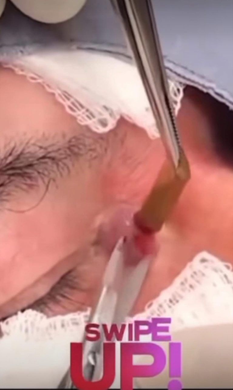The miracle of healing acnes