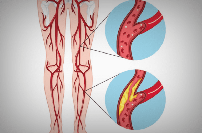 10 Signs You’re Living With Clogged Arteries