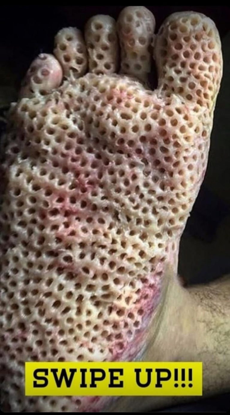 HOW TO TREAT DRY FEET