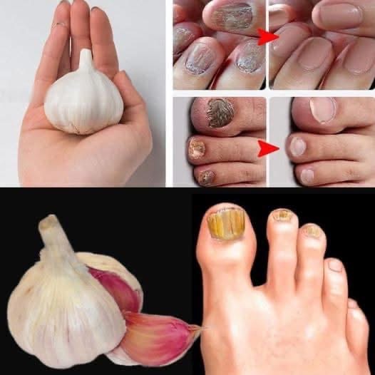Erase Nail Fungus Naturally-