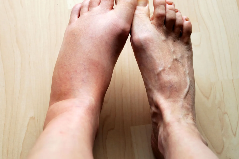 This Vitamin Removes Swelling in the Feet and Legs!!