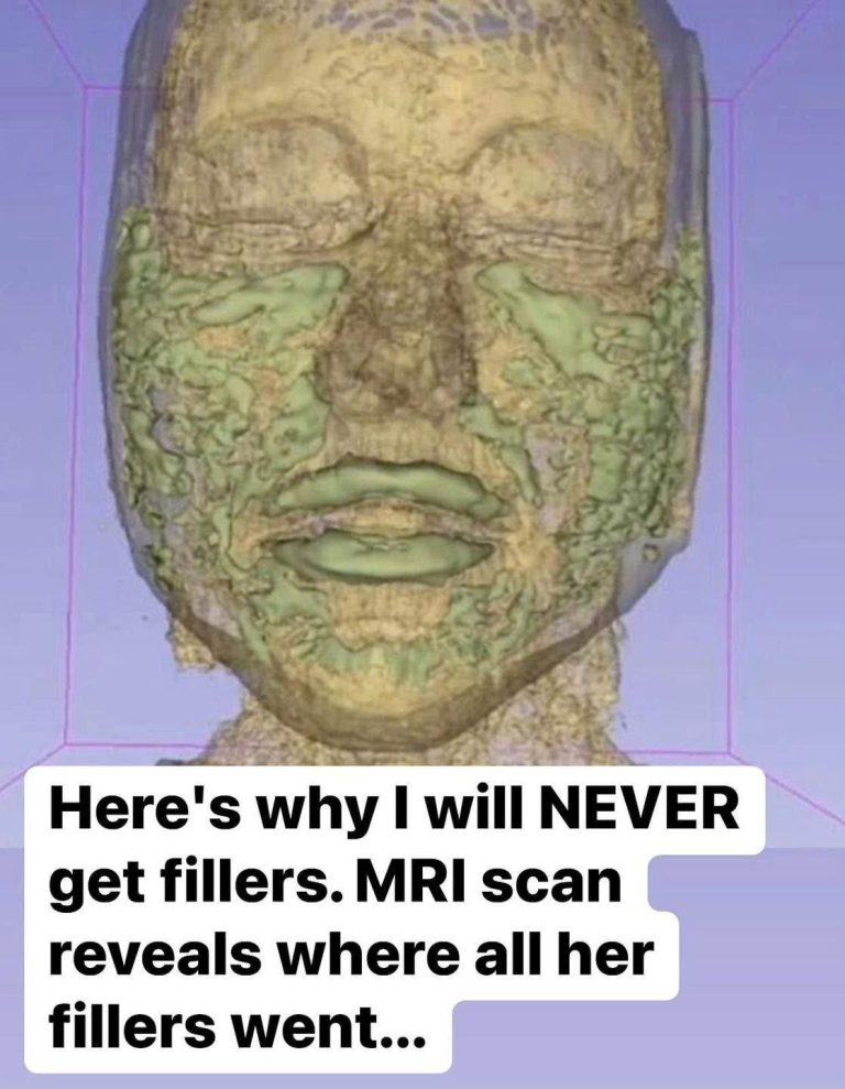 Doctor Reveals: MRI Scan Of The Face Of A 33-Year-Old Woman Reveals Where All Of Her Filler Went!!