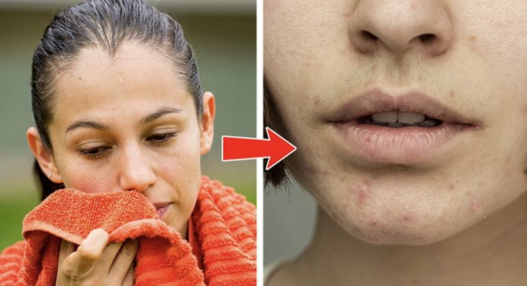 What the Acne on 5 Body Parts Is