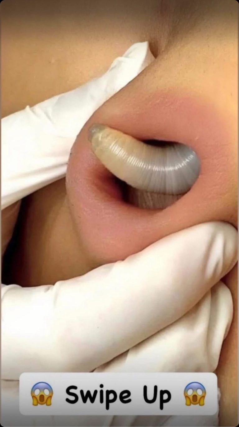 Why You Keep Getting Pimples Inside Your