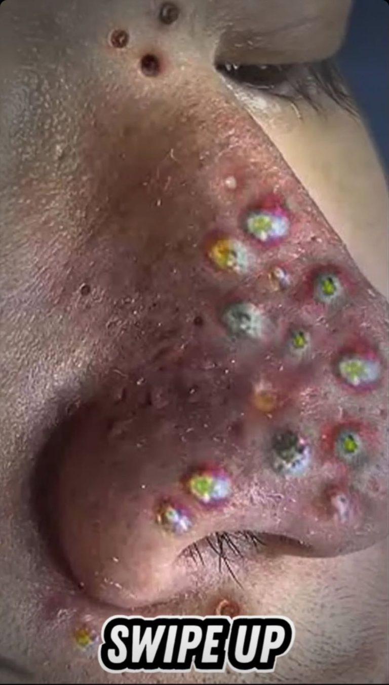 Their acne is severe