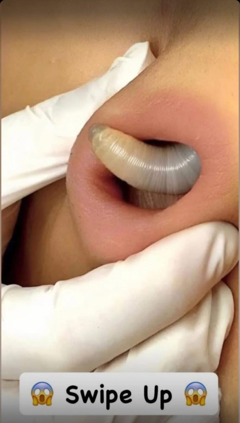 Why You Keep Getting Pimples Inside Your