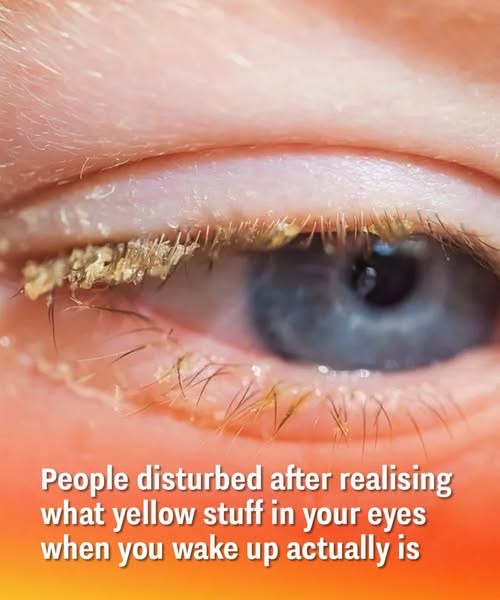 People disturbed after realizing what yellow stuff in your eyes when you wake up actually is