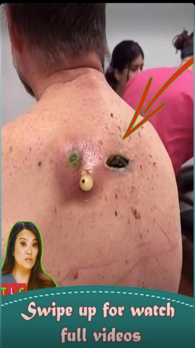 Acne And Everything You Need To Know About Them