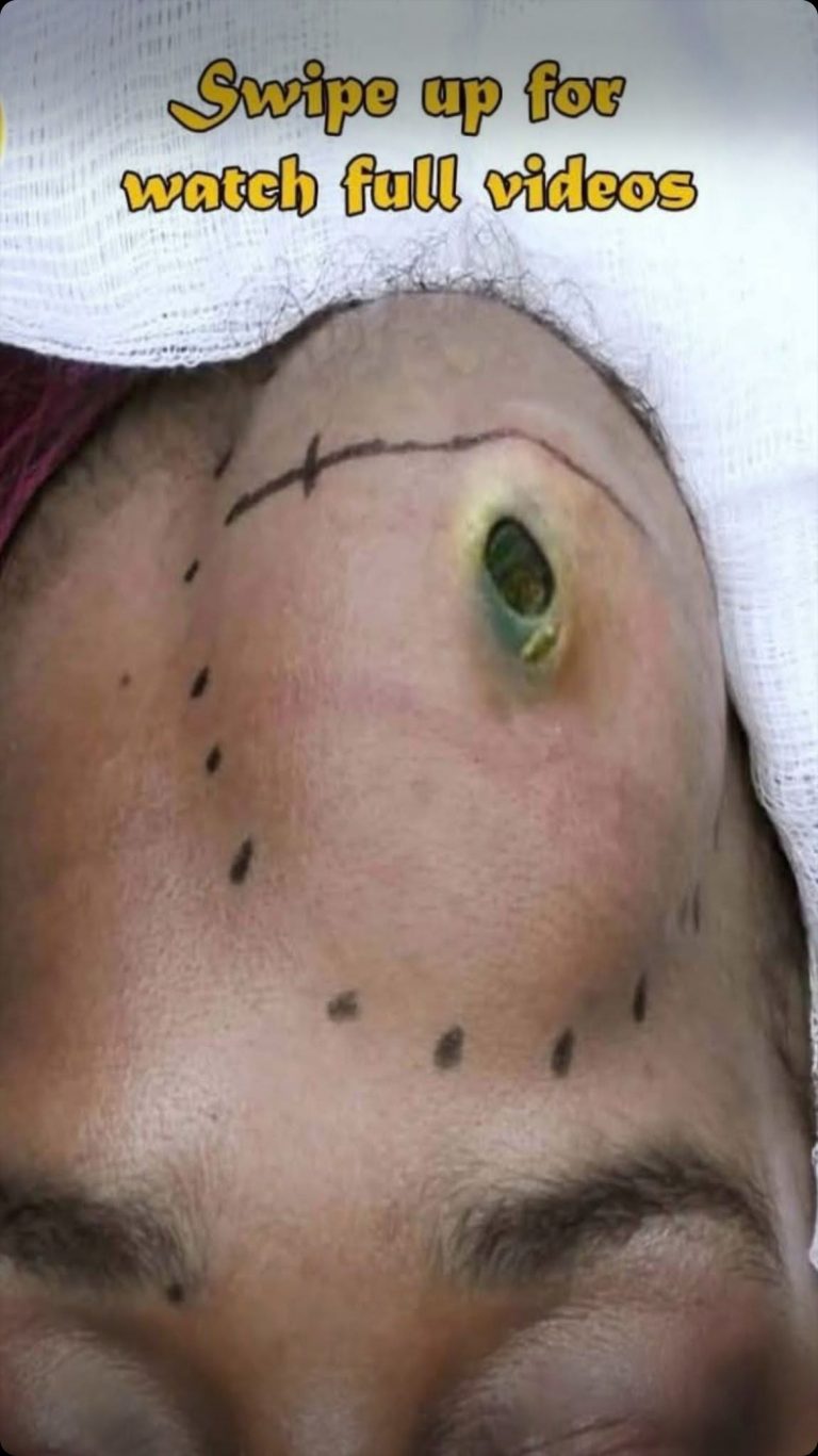Please do not look at these 9 pictures If You Have A Body Acne