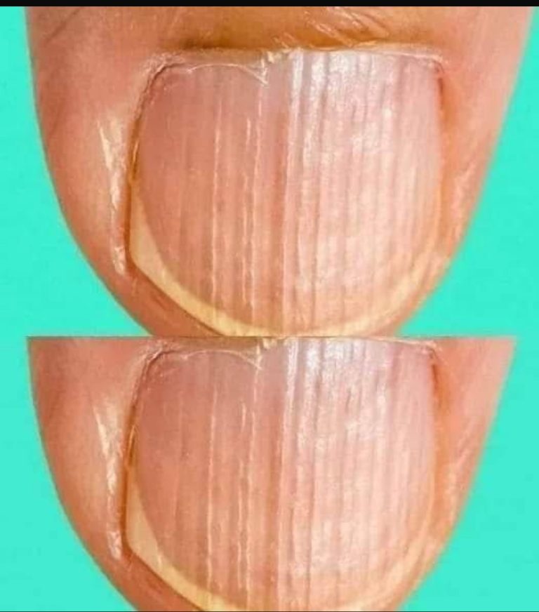 Having Striped Nails – Could Mean That Your Body Is… More Details below