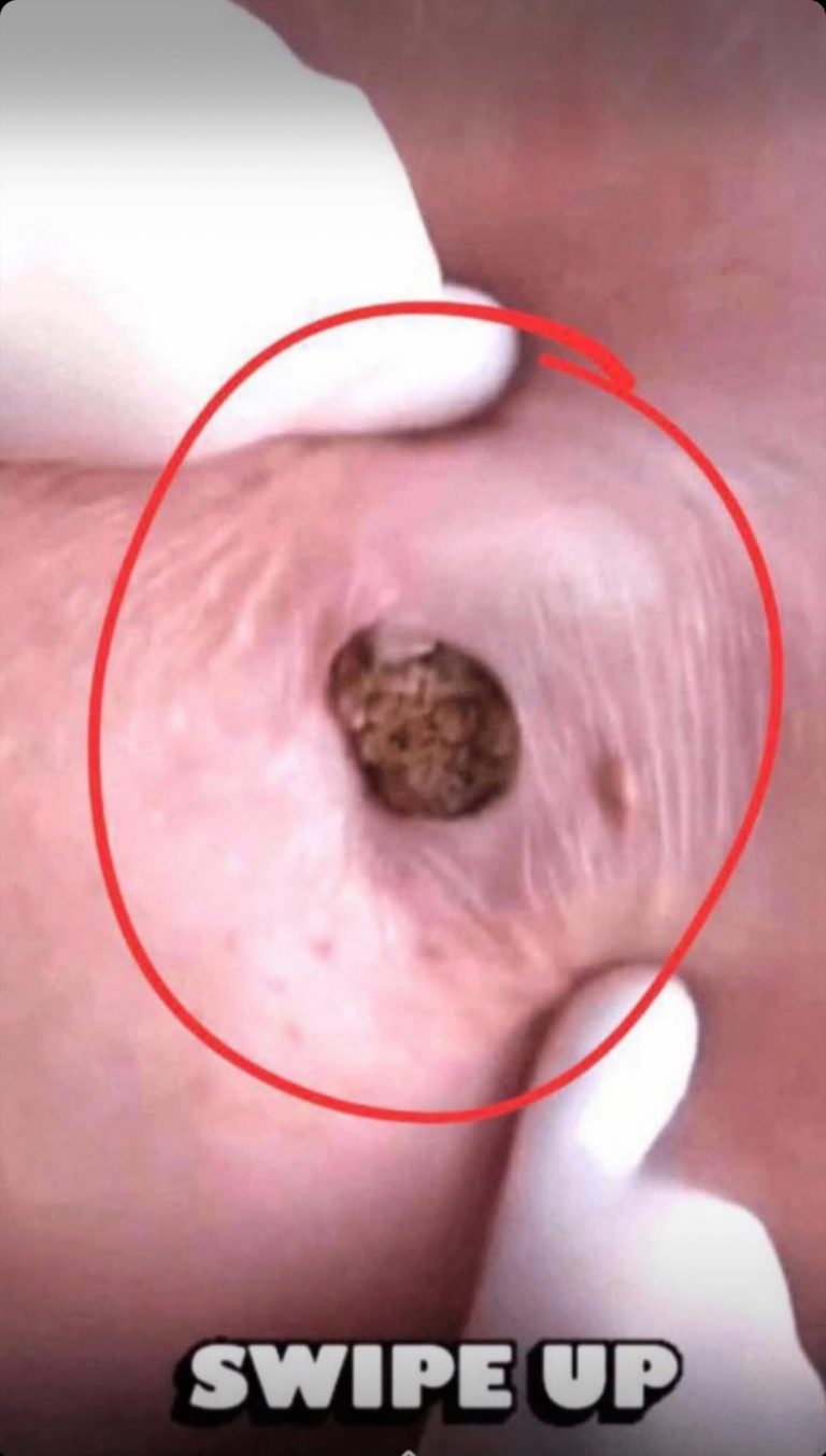 How to Treat Pimples: Gentle, Proven Solutions f
