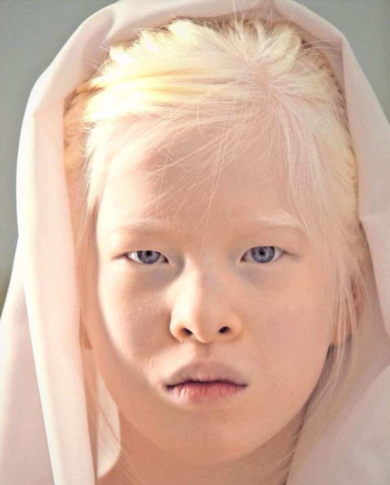 Abandoned as a baby due to her looks, she’s determined to prove everyone wrong and is now featured in Vogue.
