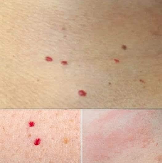 If you spot these red dots on your skin, here’s what they