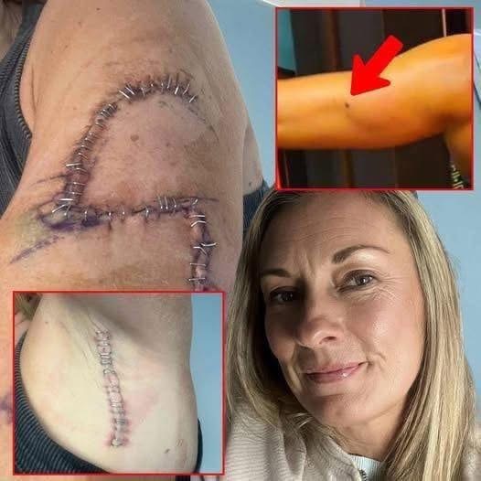 TG She Thought It Was Just A Mole… 77 Stitc