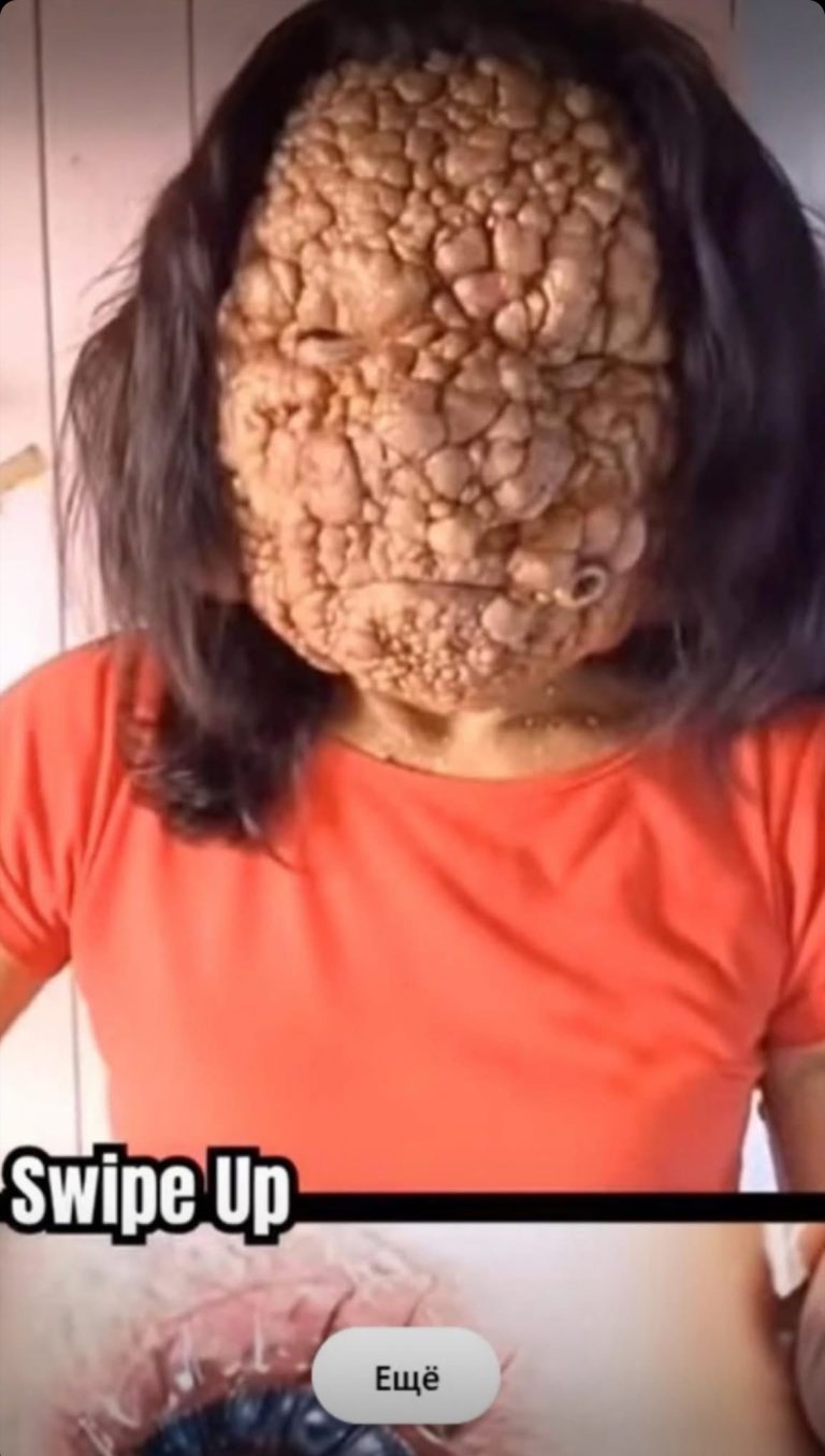 Acne occurs when hair follicles