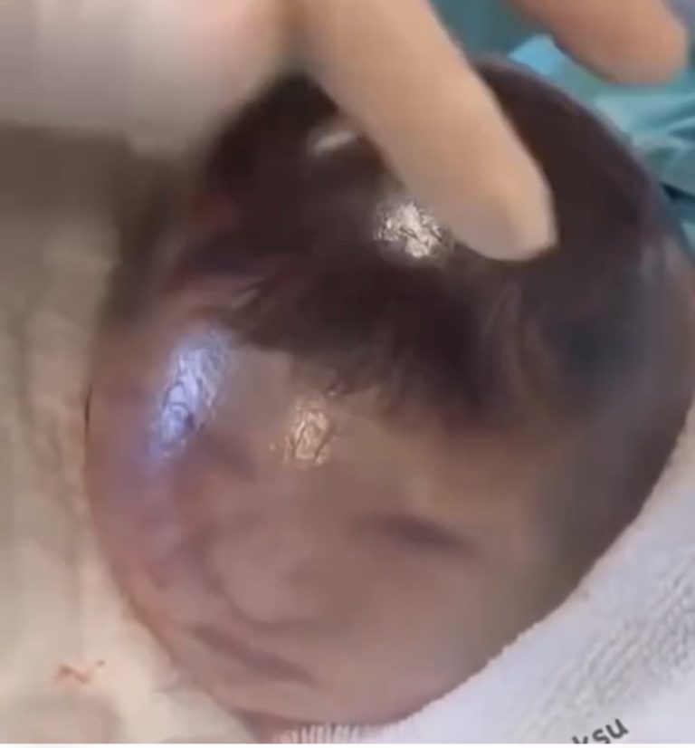 Baby born with an DIU peg