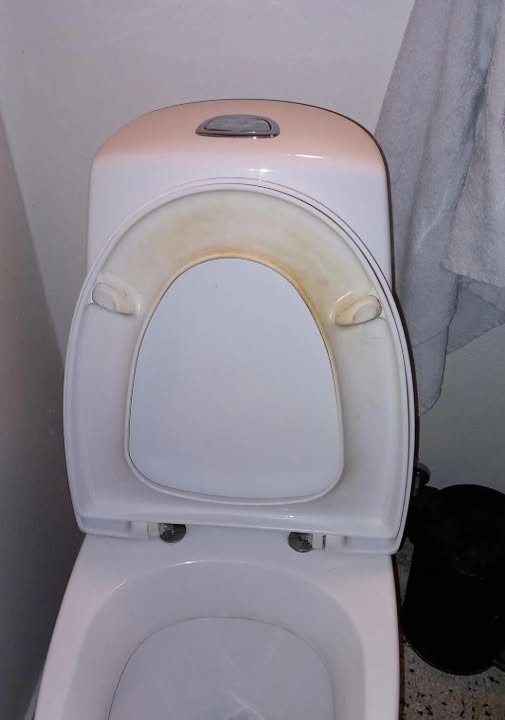 Tired of that nasty yellow ring? Here’s how I got rid of it for good