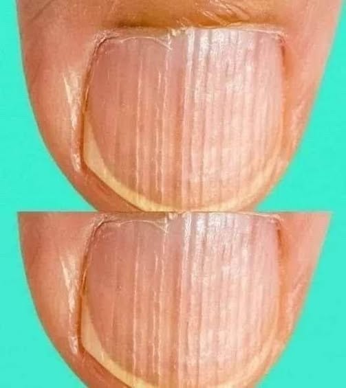 Having Striped Nails Could Mean That Your Body Isโฆ More Details below