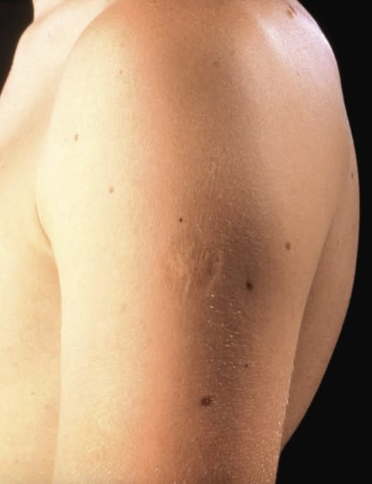 Smallpox vaccine scars: What they look like and why