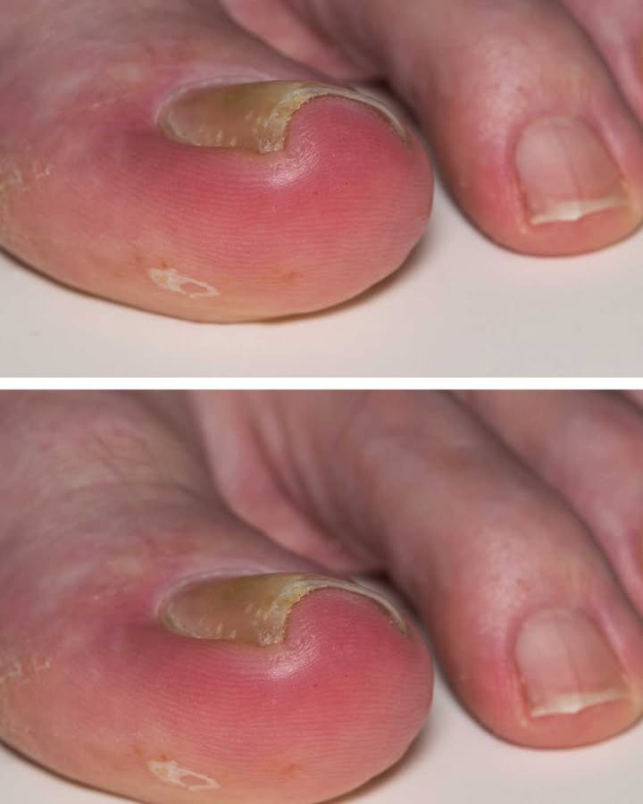 Ingrown Toenail Pain: Early Signs and Safe Home Care
