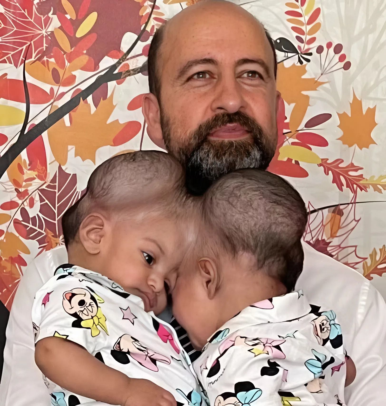 The sisters were born with one head for the two of them, but when they turned 3, doctors separated them