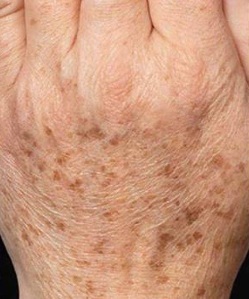 The Truth Behind Those Mysterious Hand Spots