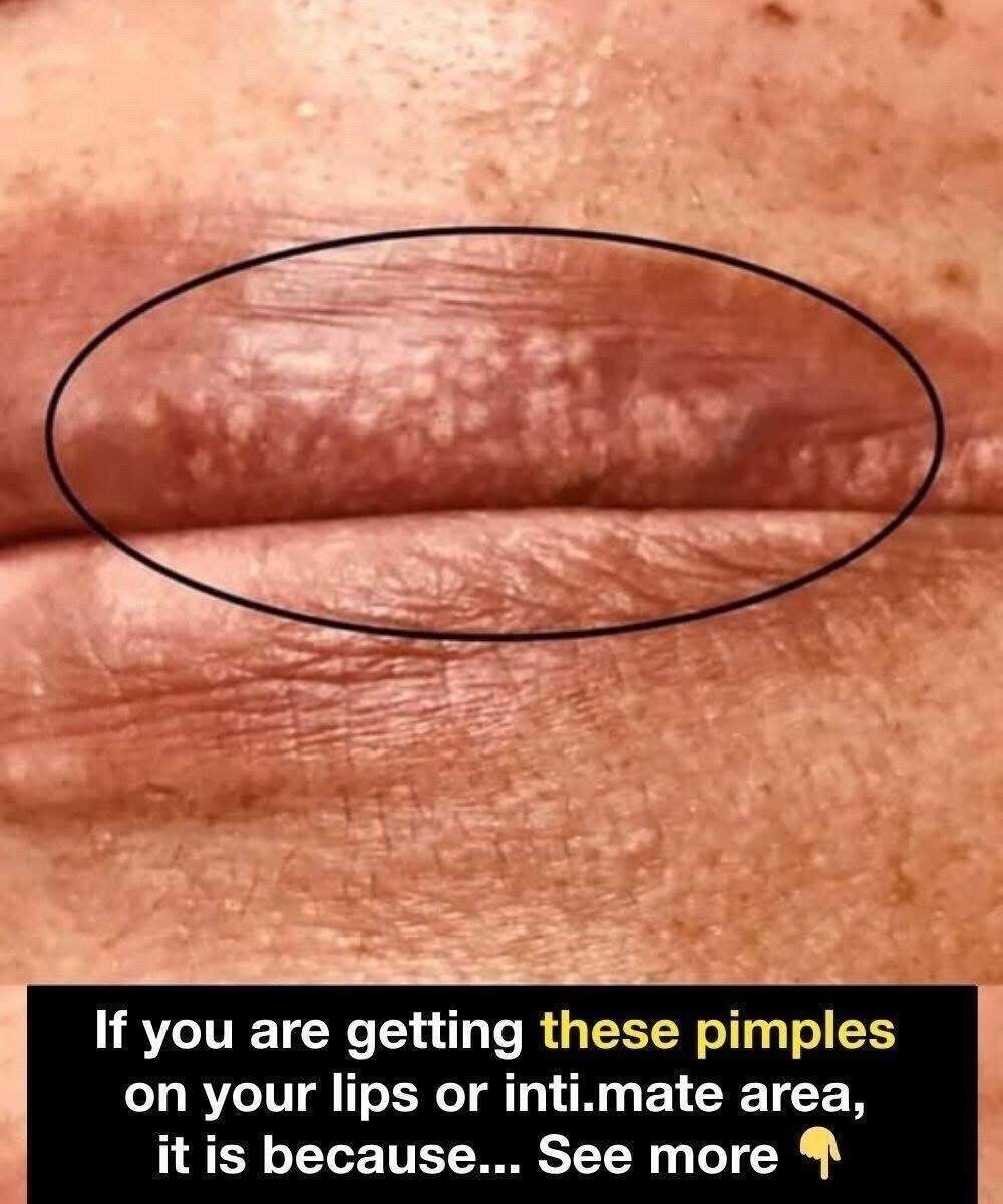 Understanding White Pimples on Your Lips: 