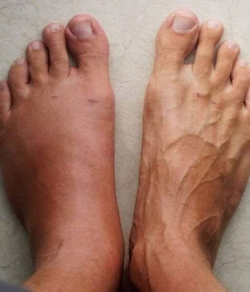 One Month Before a Heart Attack, Your Body Will Alert You: Here Are the 6 Symptoms!