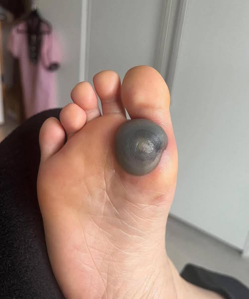 My daughter woke up with this huge spot on her foot I don’t know what it could be. She’s been in pain and can’t move her foot what is this.. 