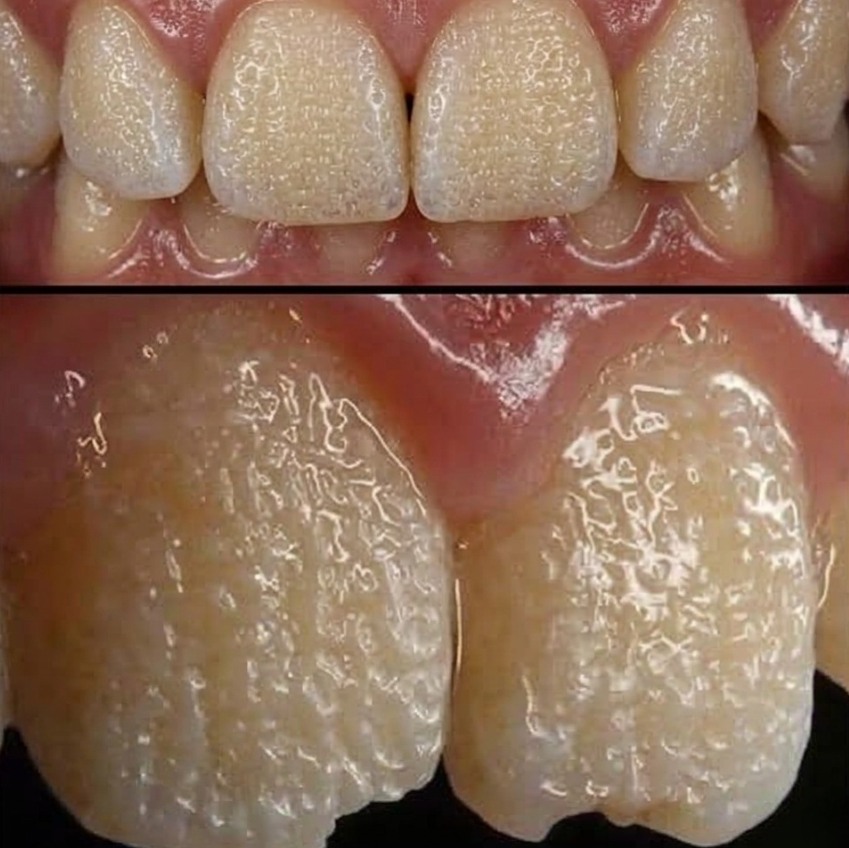 Be Careful! This Is What Can Happen to Your Teeth When You Eat Certain Everyday Foods and Drinks That Slowly Damage Enamel, Cause Staining, Increase Sensitivity, and Lead to Long-Term Dental Problems You Might Not Notice Until It’s Too Late to Reverse the Effects
