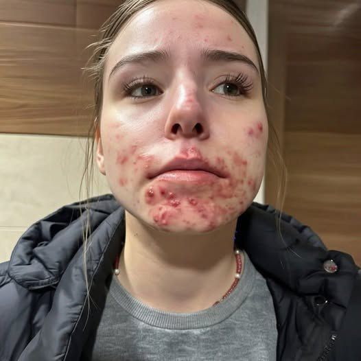 The Hidden Reasons You Keep Getting Pimples on Your Chin