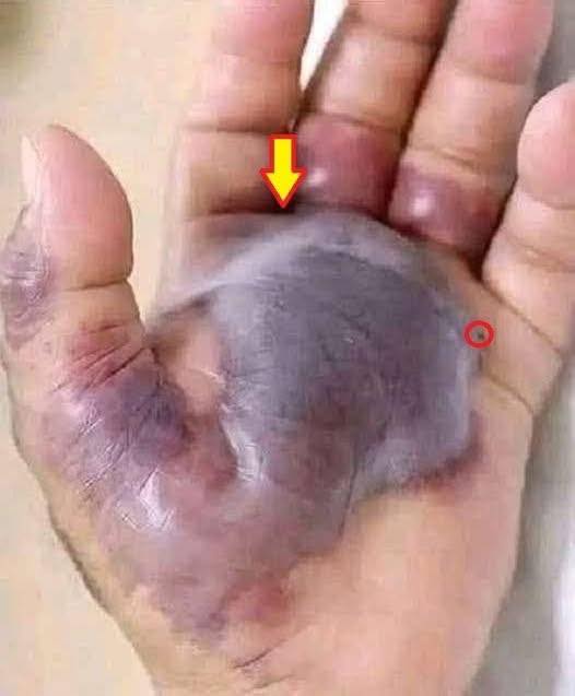 Doctors Are Warning Everyone This Small Bite Turned a Hand Black, And It Could Happen to Anyone