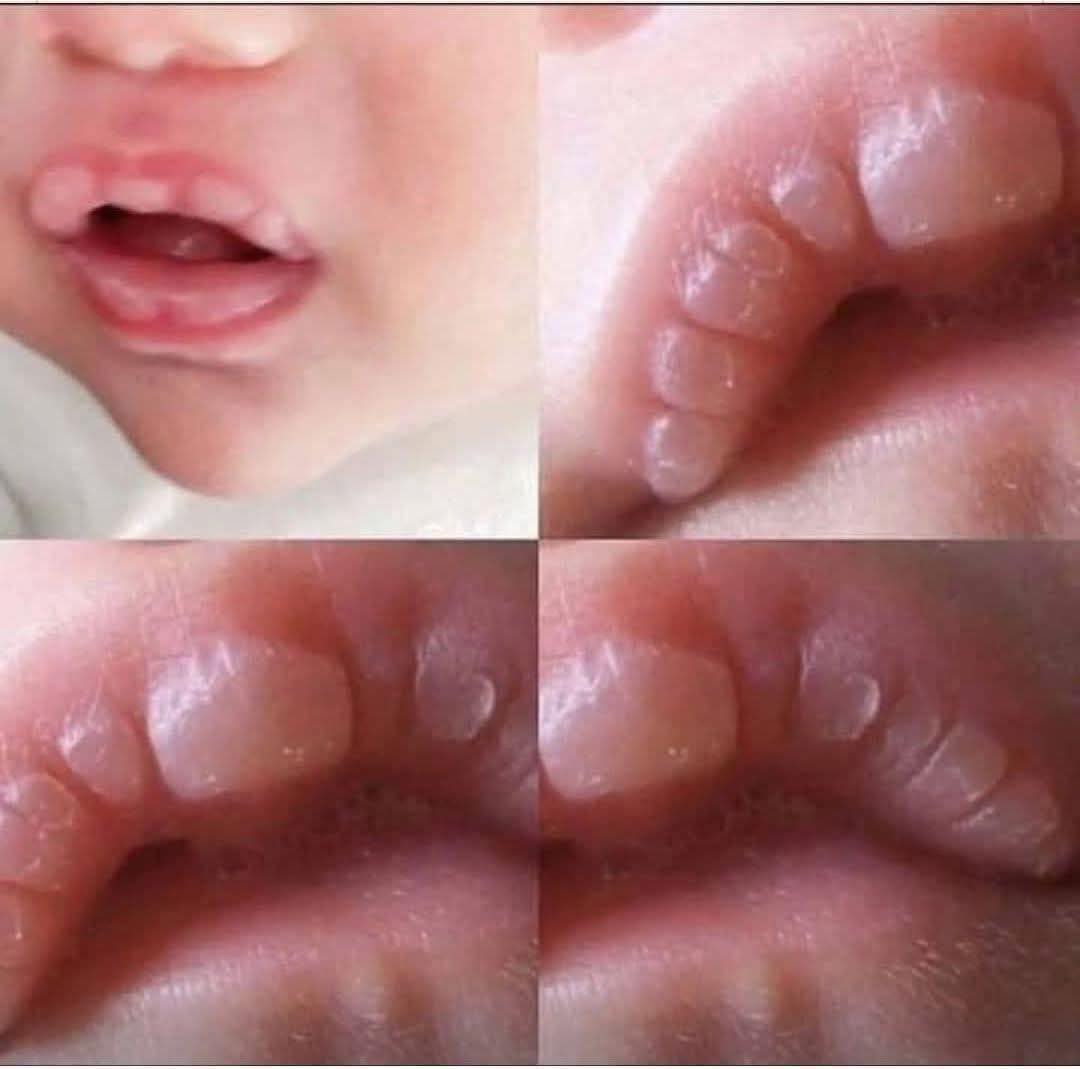 If your baby has these marks