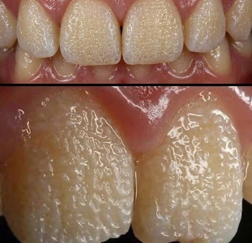 Be Careful! This Is What Can Happen to Your Teeth When You Eat Certain Everyday Foods and Drinks 
