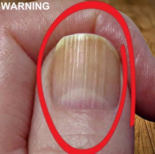 Why Vertical Lines on Your Nails Often Appear With Age