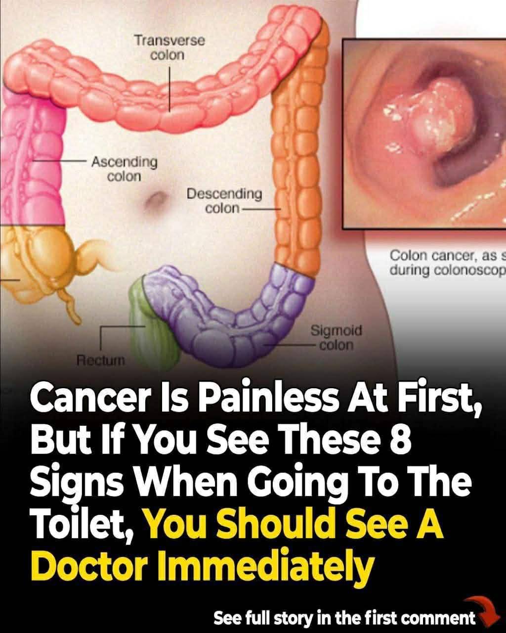 How Your Bowel Movements Reveal Clues About Colon Cancer