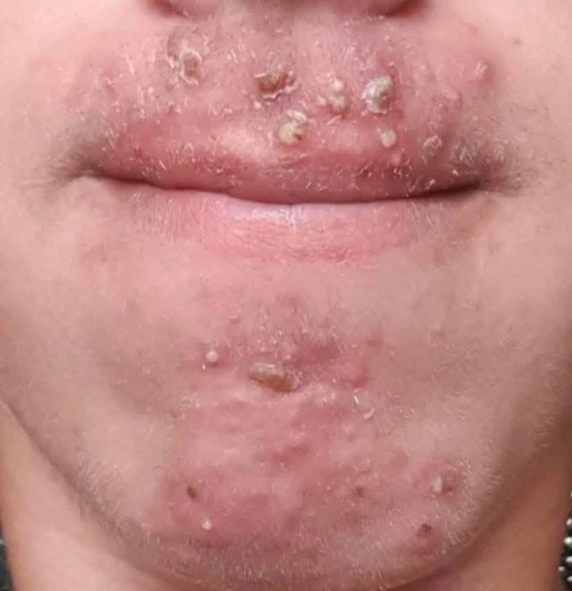 Been dating this woman I met at Walmart and after finally getting some I woke up with these on my face what is this?