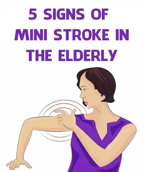 5 stroke signs every woman should know after Dr. Pimple Popper star suffers stroke while filming