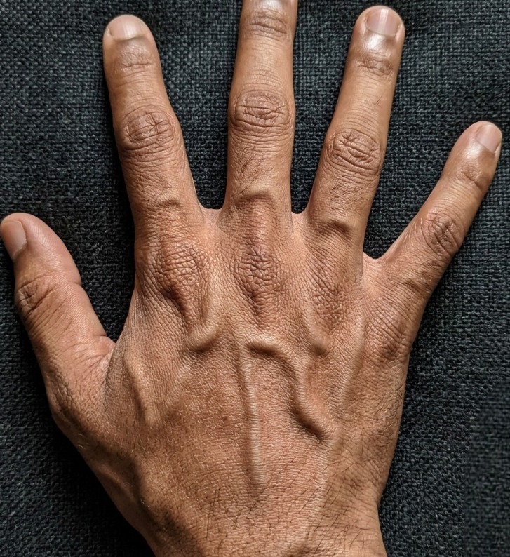 Visible Hand Veins Explained: 