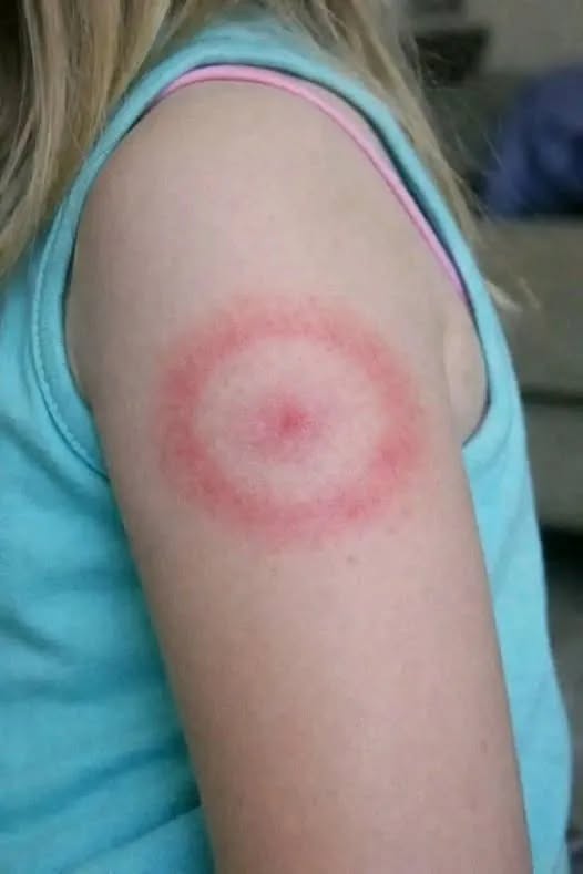 How to identify and cure skin fungu